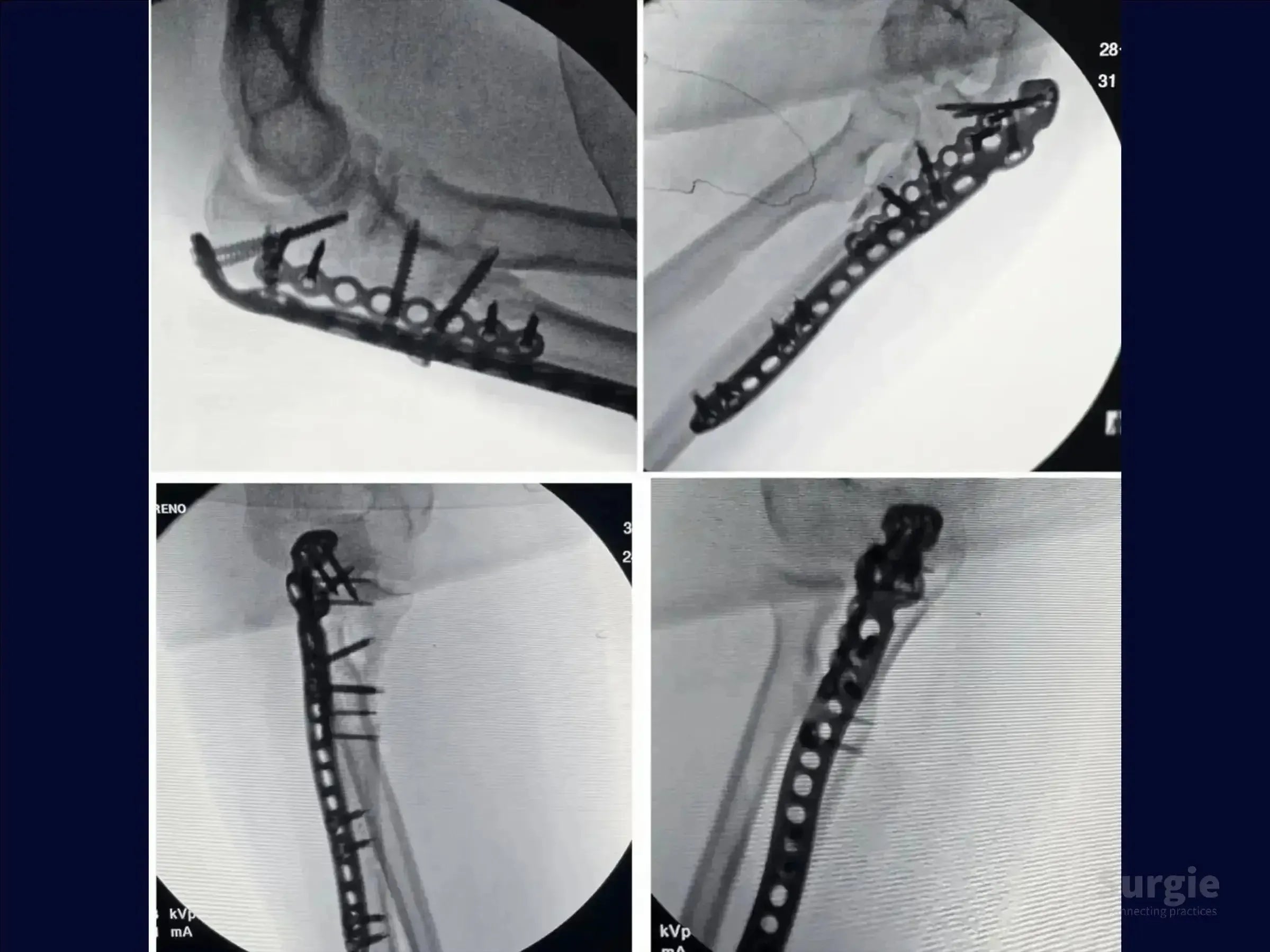 X-ray showing internal fixation of a transolecranon fracture with a contoured metal plate and multiple locking screws.