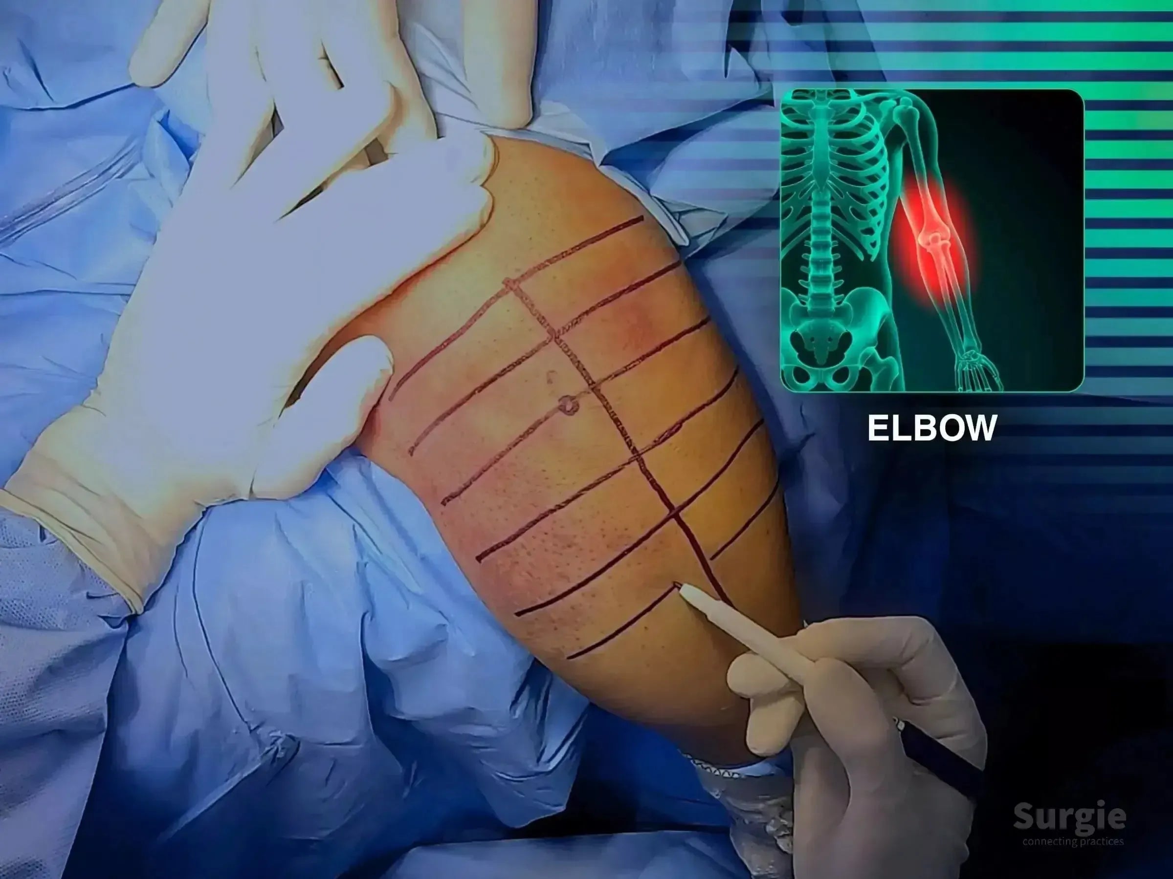 Surgeon marking a patient's elbow for Monteggia fracture surgery with an anatomical diagram overlay.