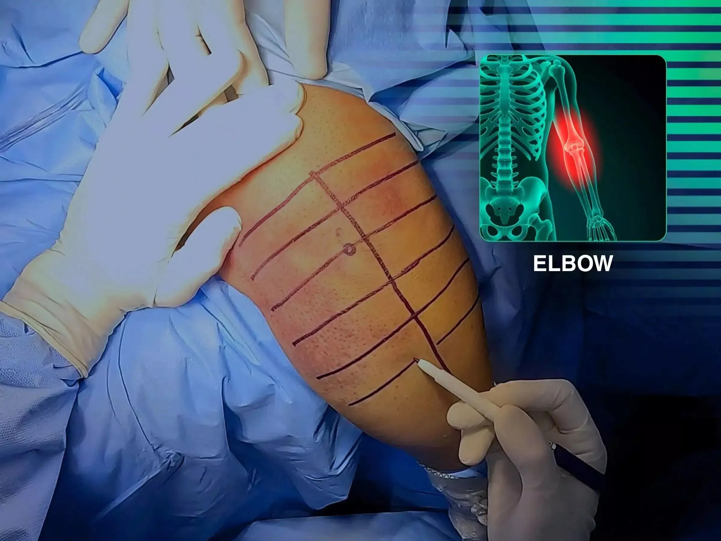 Transolecranon Fracture-Dislocation of the Elbow (Monteggia Variant) – "Pull-out" Technique