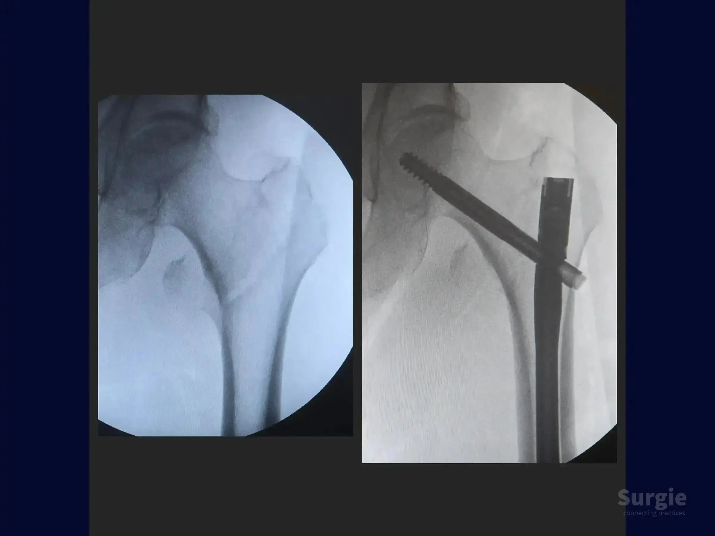 X-ray showing a transtrochanteric femur fracture before and after intramedullary nail fixation with a sliding screw.