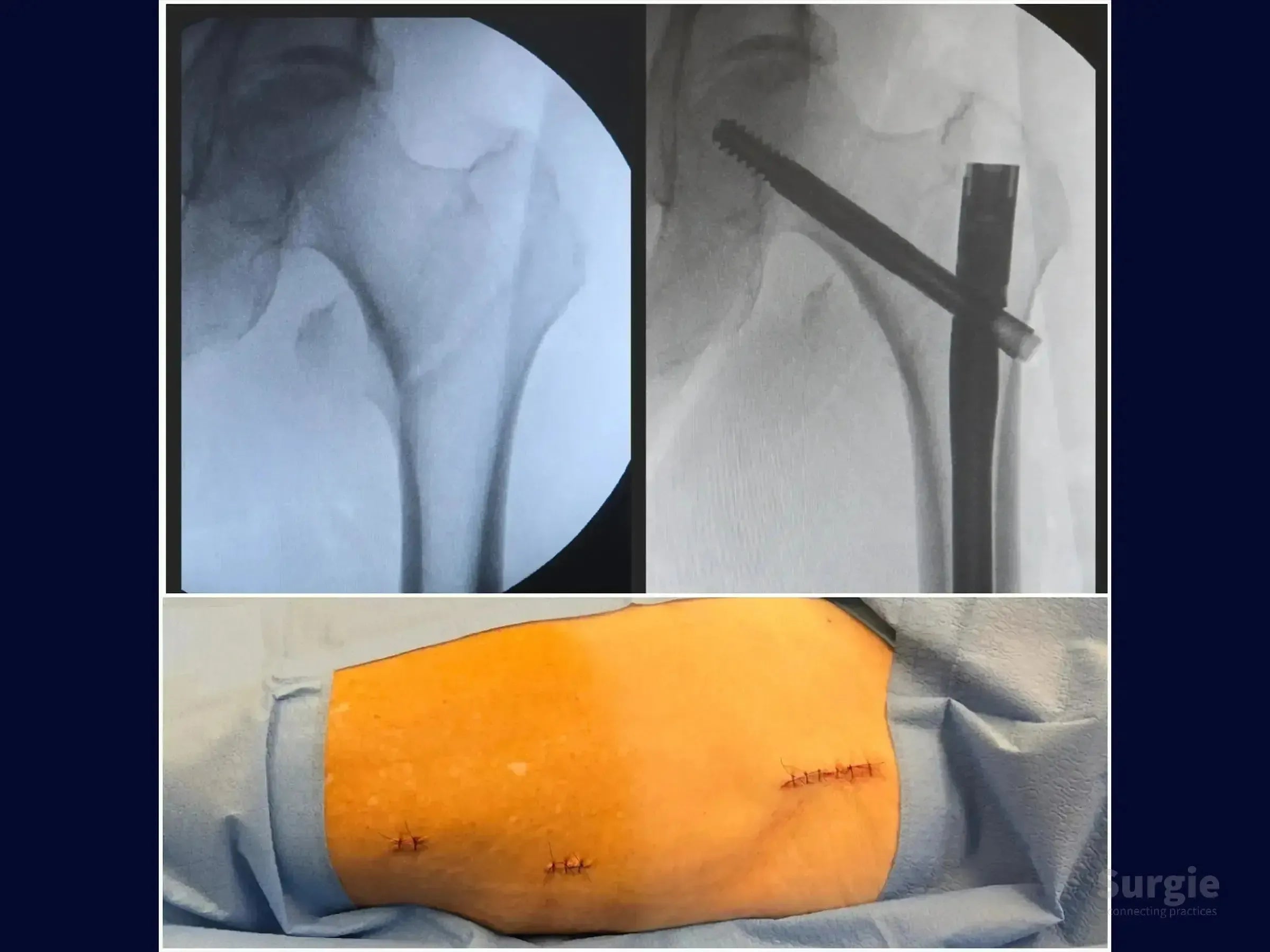 X-ray showing a transtrochanteric femur fracture fixed with an intramedullary nail and post-surgical incisions with sutures.