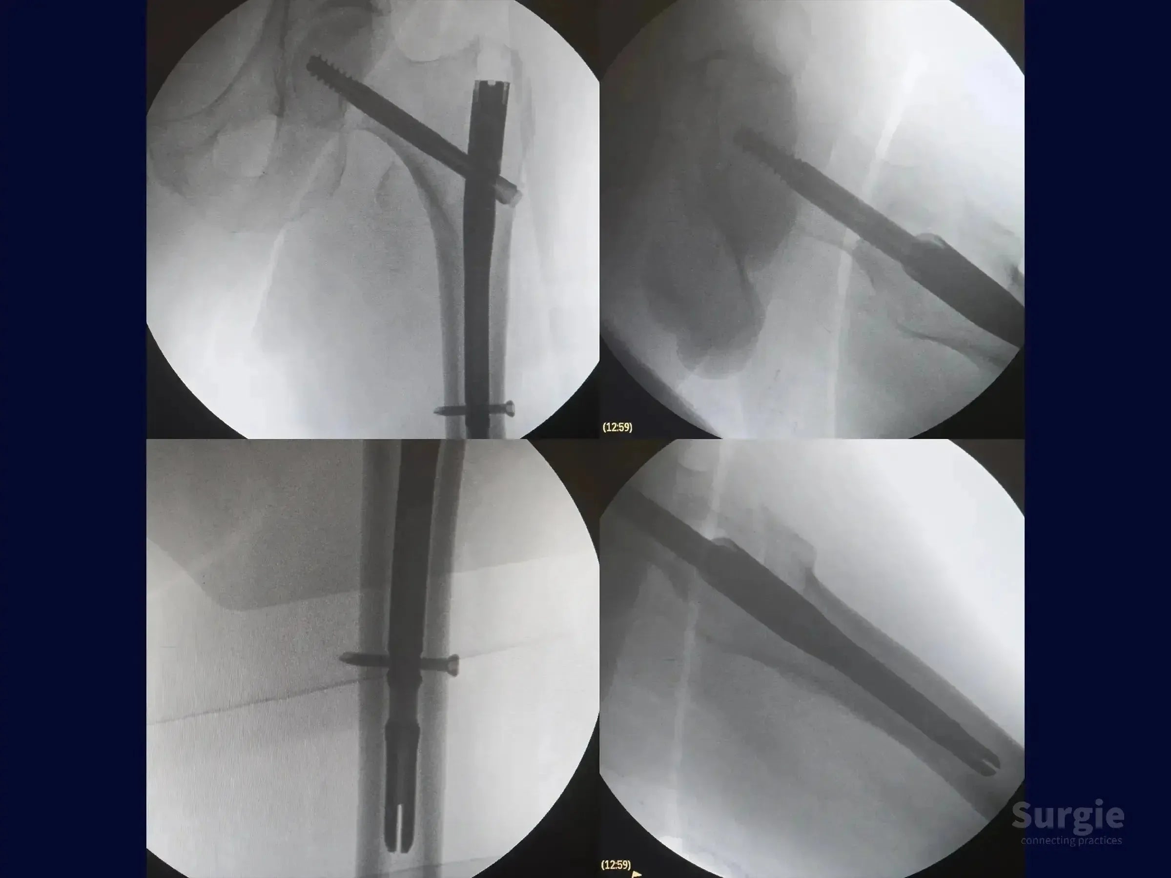 Fluoroscopic X-ray views showing an intramedullary nail fixation for a transtrochanteric femur fracture.