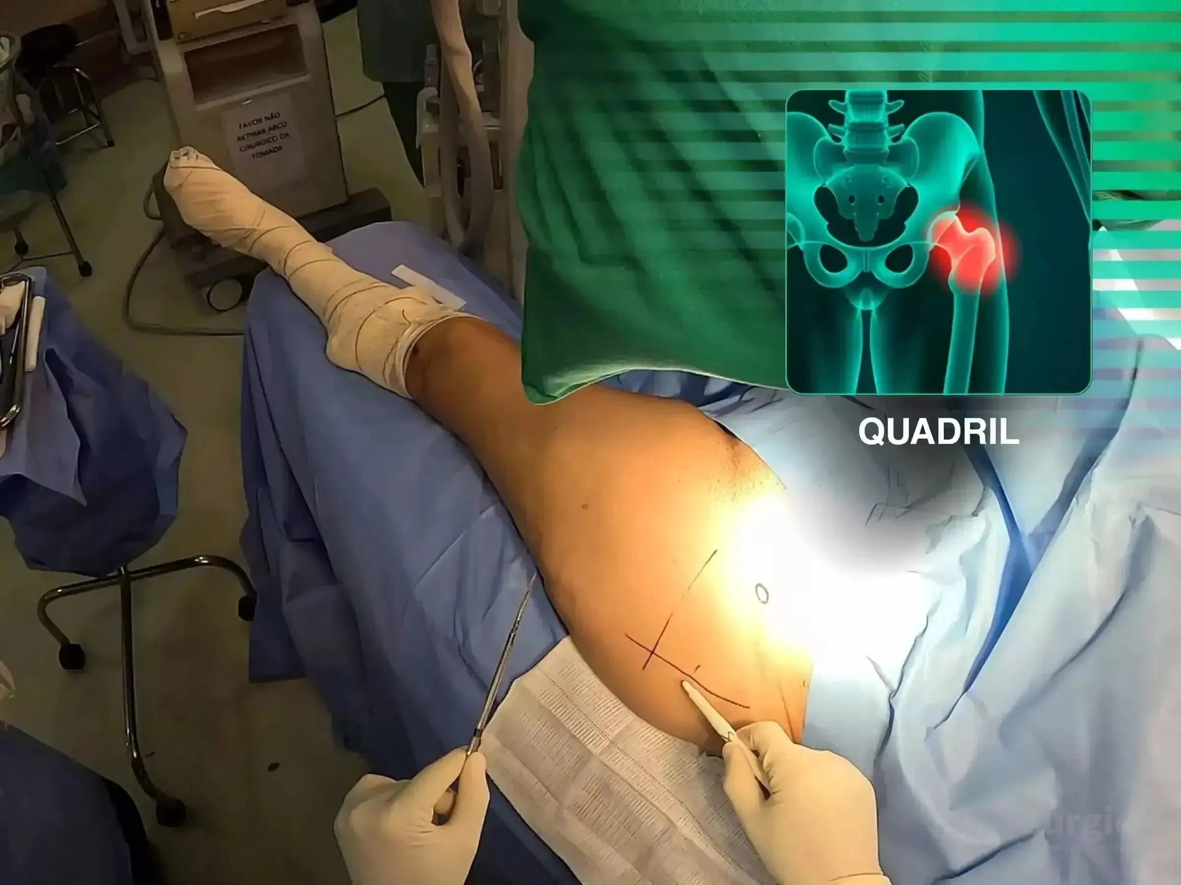 Surgeon marking a hip incision site for intramedullary nailing with a digital anatomical overlay of a transtrochanteric fracture.