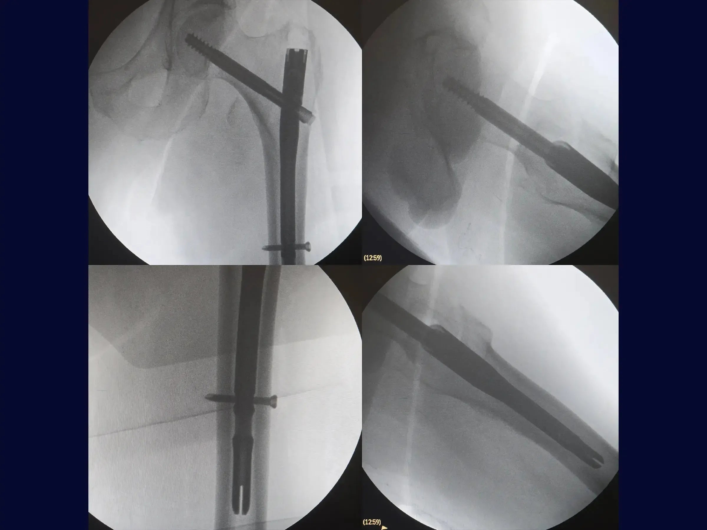 Transtrochanteric Fracture with Intramedullary Nail (Without Traction Table) 01