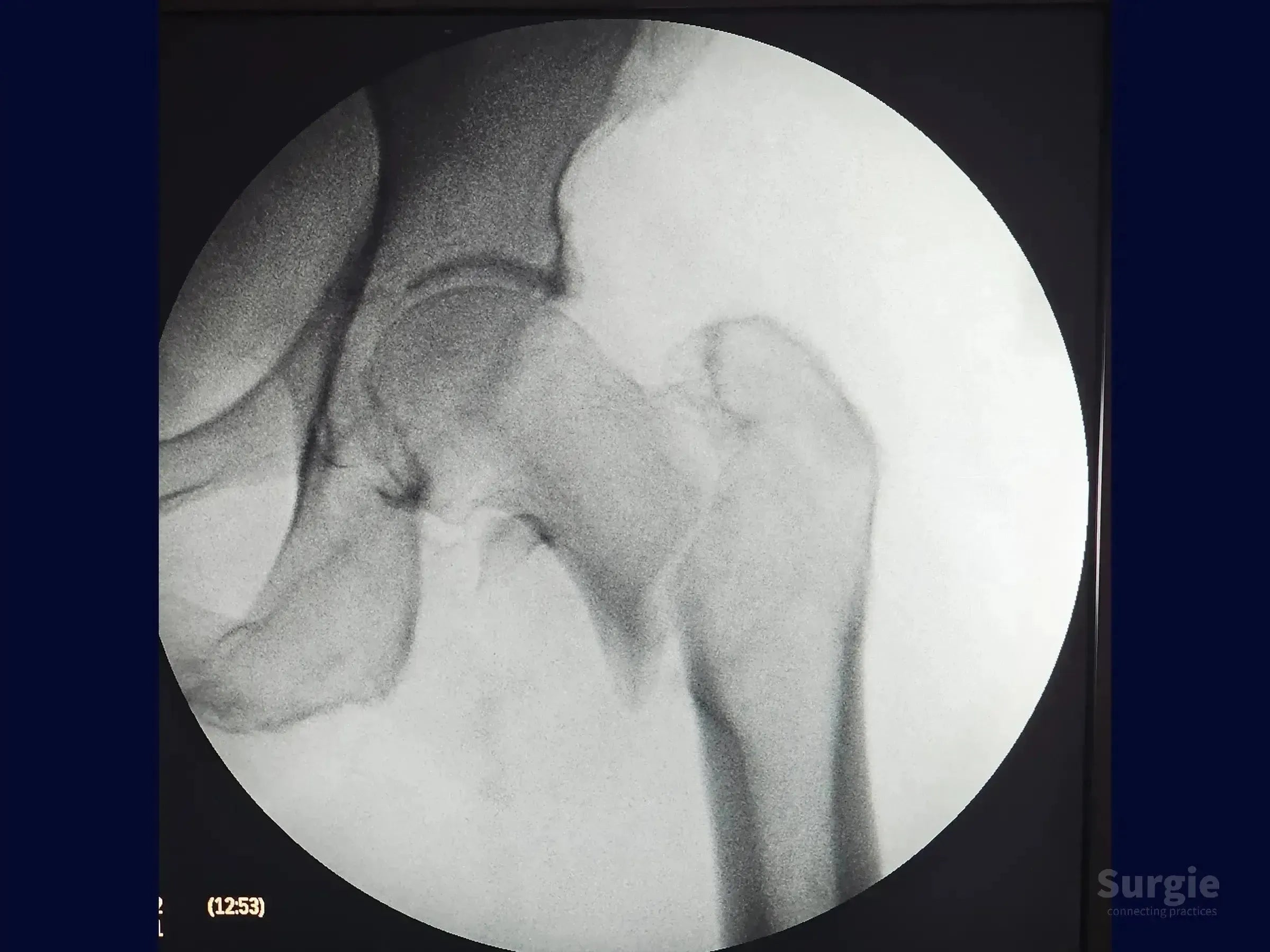 Fluoroscopic X-ray showing an unstable proximal femur fracture of the hip joint in grayscale.