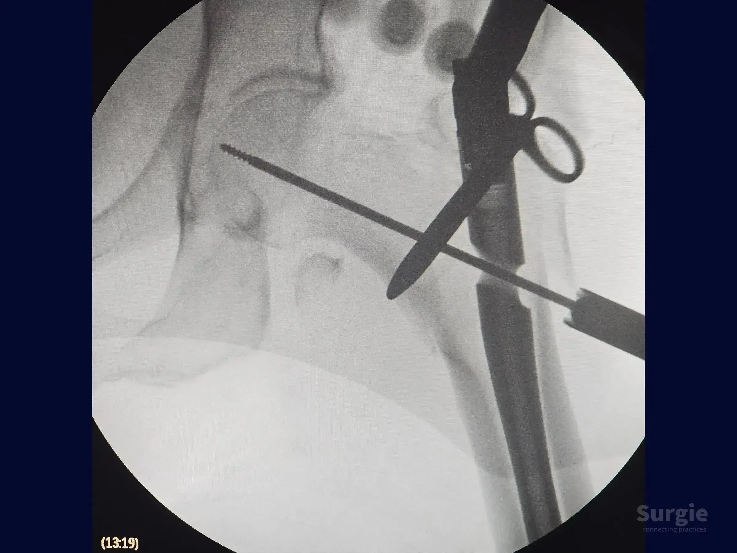 Fluoroscopic view of a proximal femur fracture being reduced with an intramedullary nail and a surgical clamp.