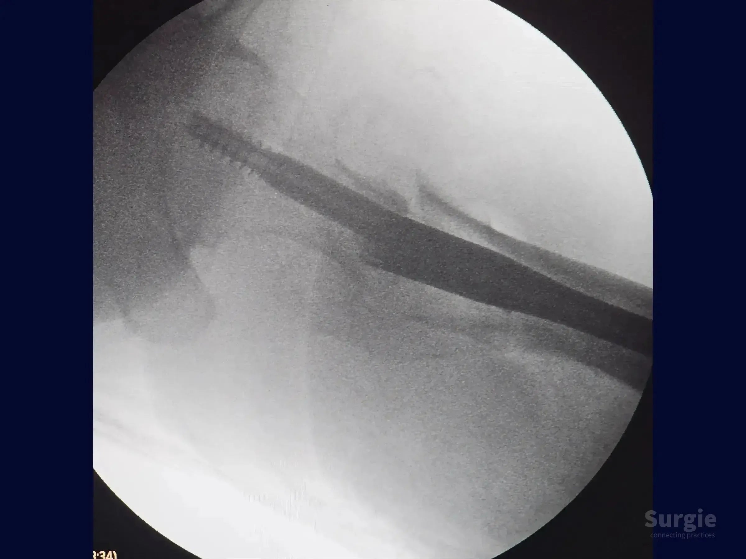 Fluoroscopic X-ray showing intramedullary nail insertion during proximal femur fracture osteosynthesis.
