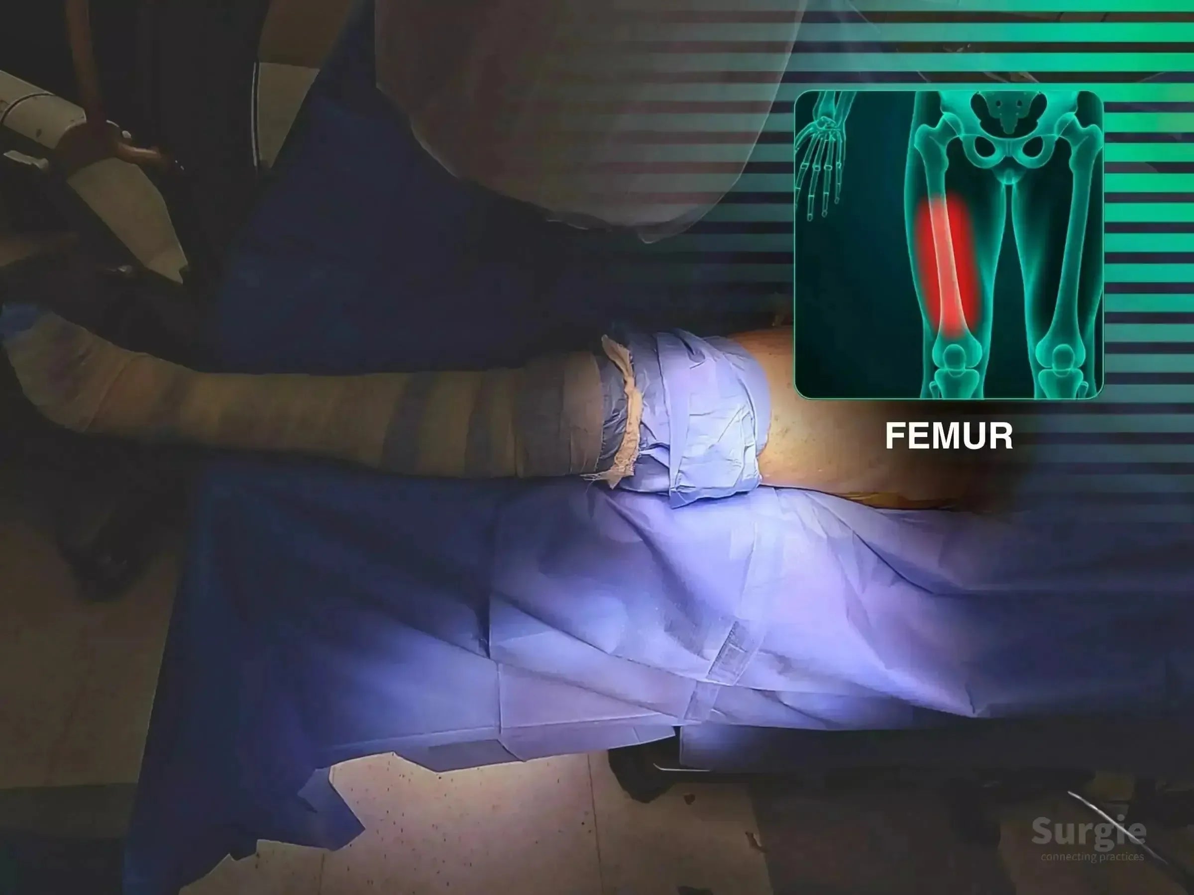 Surgical setup for proximal femur fracture with blue drapes and an anatomical overlay highlighting the femur.