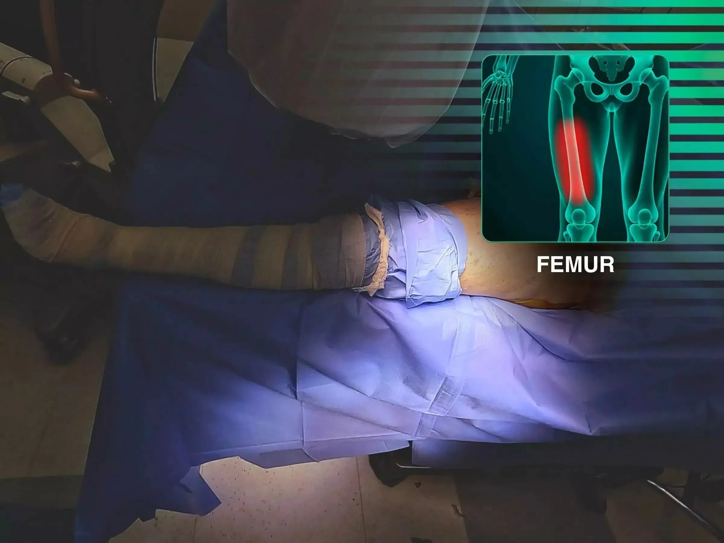 Treatment of Proximal Femur Fracture with Intramedullary Nail and See-Saw Maneuver