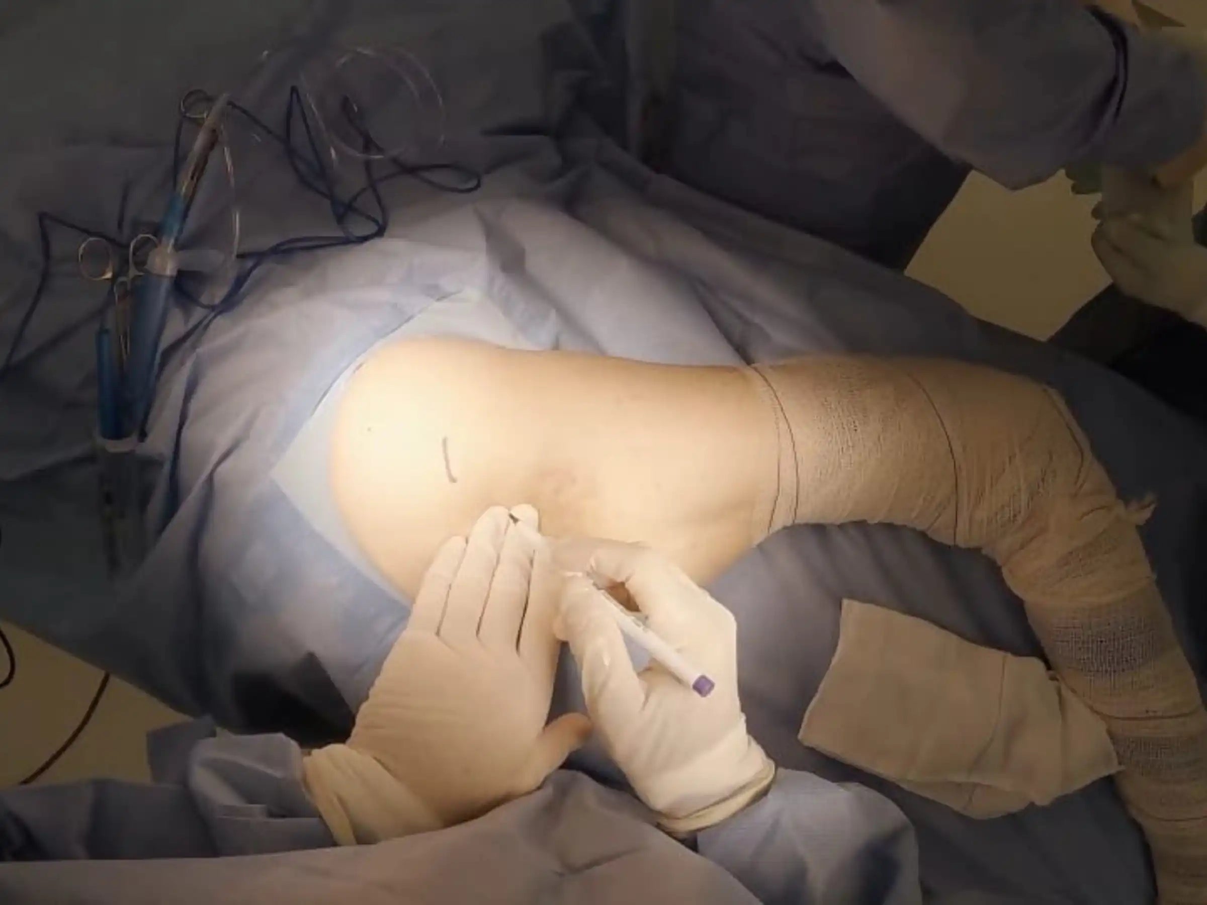 Hip Hemiarthroplasty via Hardinge Approach