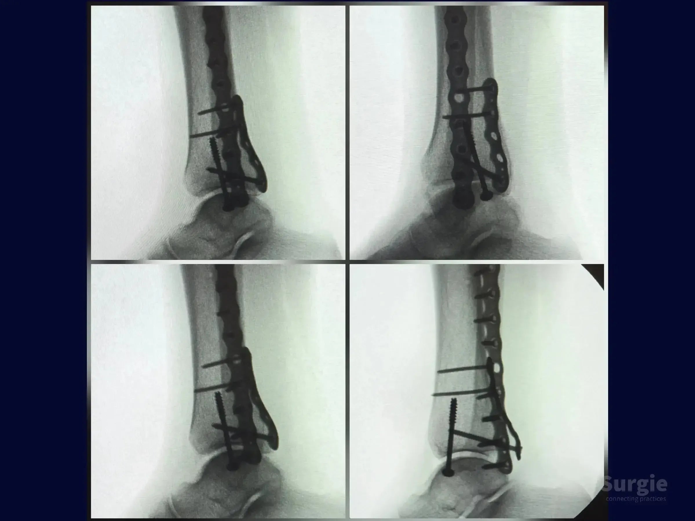 X-ray showing trimalleolar fracture fixation with metal plates and screws on the fibula and posterior malleolus.