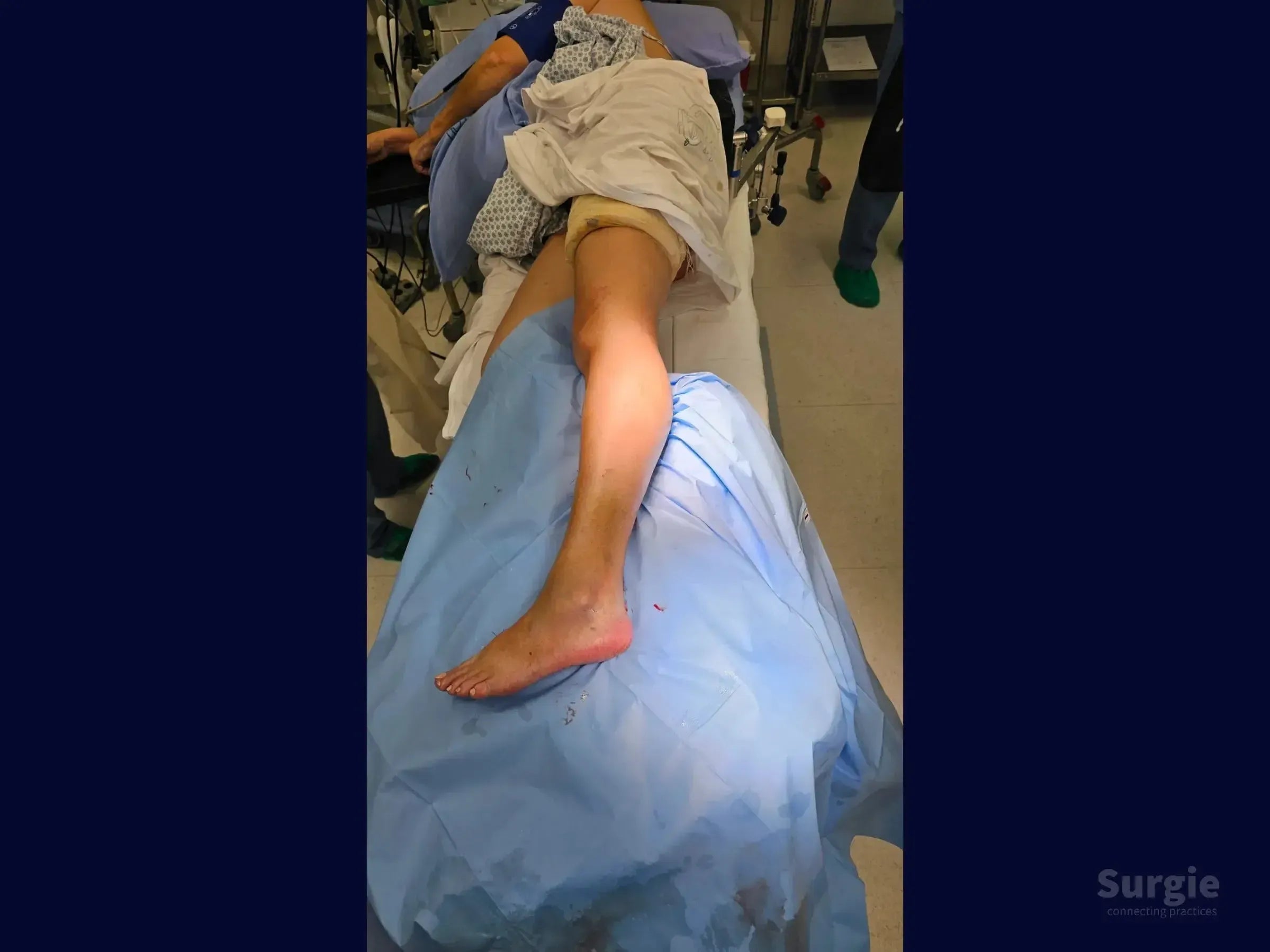 Patient in lateral decubitus position on an operating table for trimalleolar fracture surgery with blue sterile drapes.