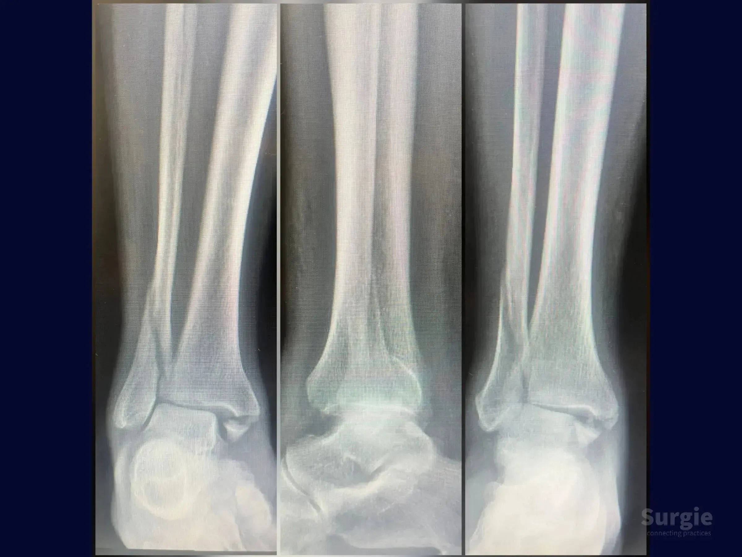 Three-view X-ray of a trimalleolar ankle fracture showing bone displacement and alignment of the tibia and fibula.