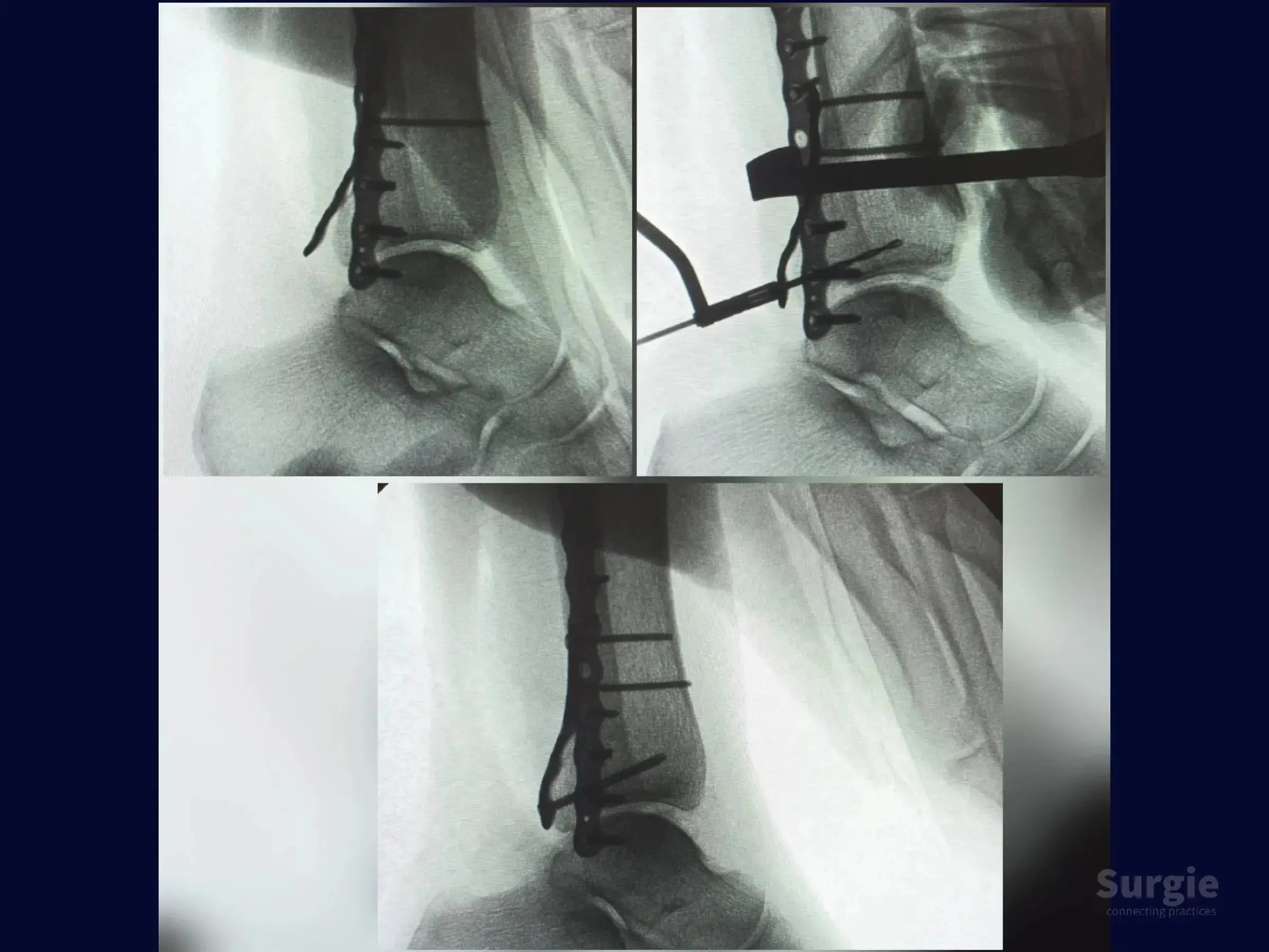 X-ray showing trimalleolar fracture fixation with a metallic locking plate and screws on the lateral malleolus.