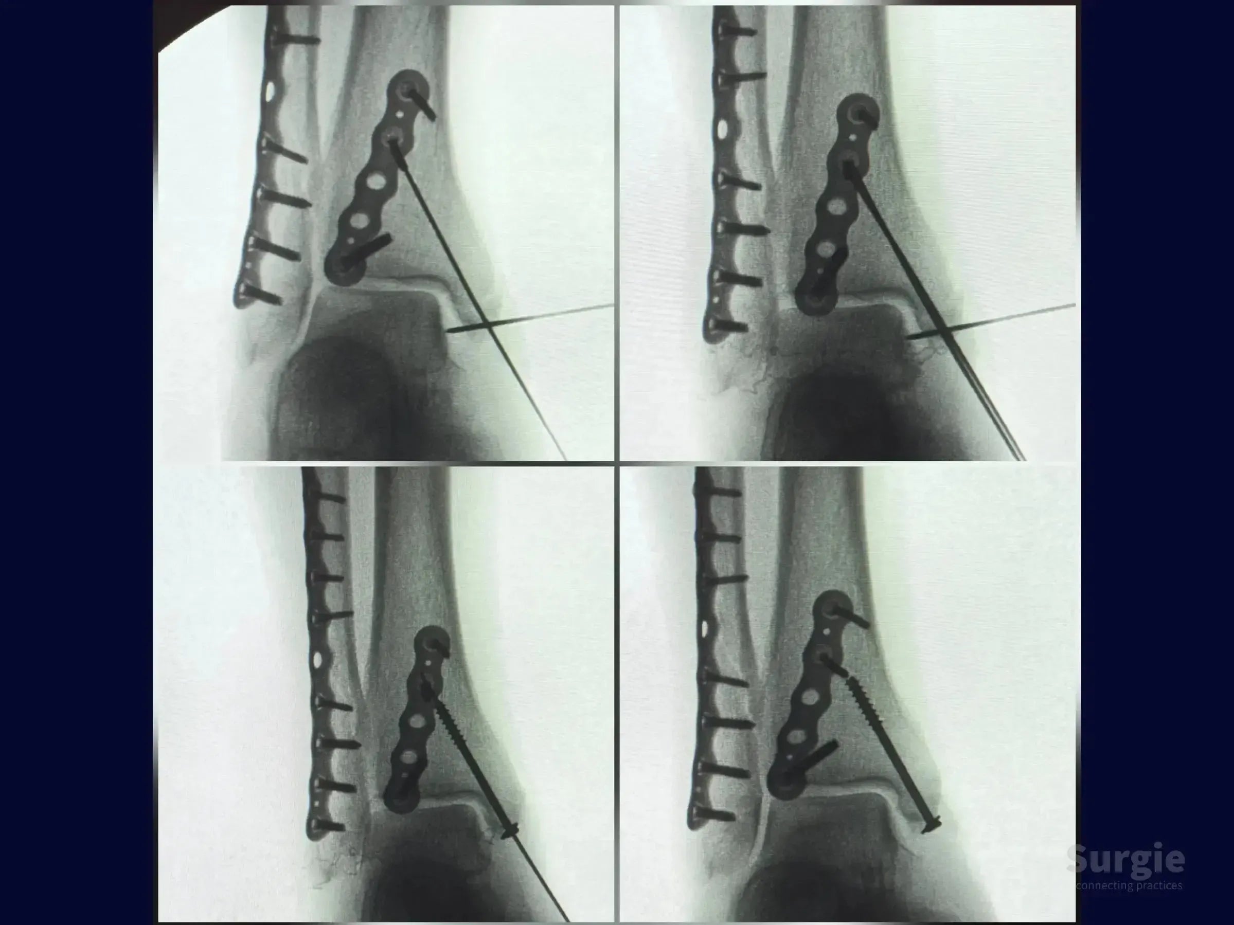 X-ray sequence showing trimalleolar fracture fixation with metal plates, screws, and guide wires in an ankle joint.