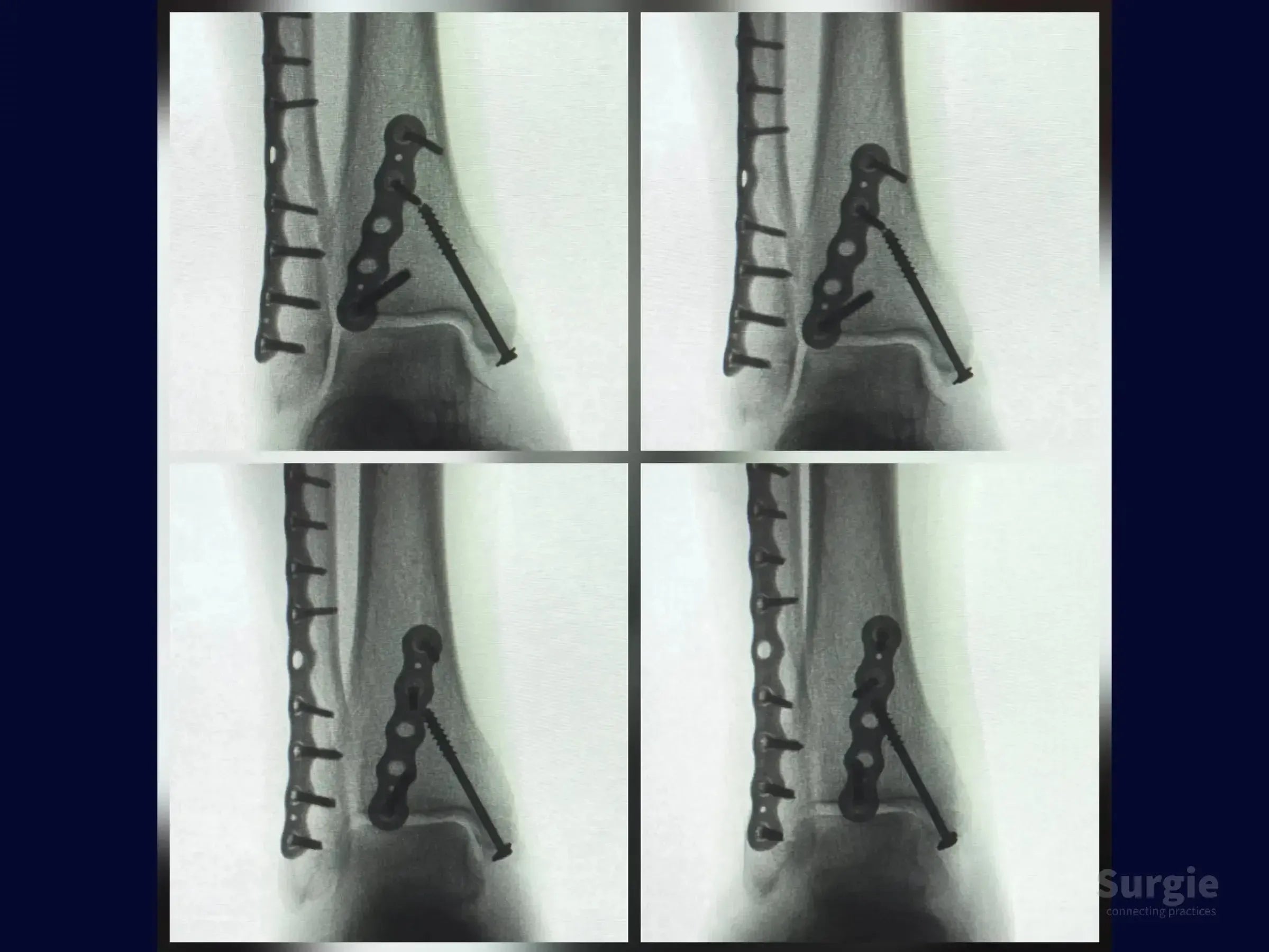 X-ray showing trimalleolar fracture fixation with metal plates and screws on the fibula and posterior malleolus.