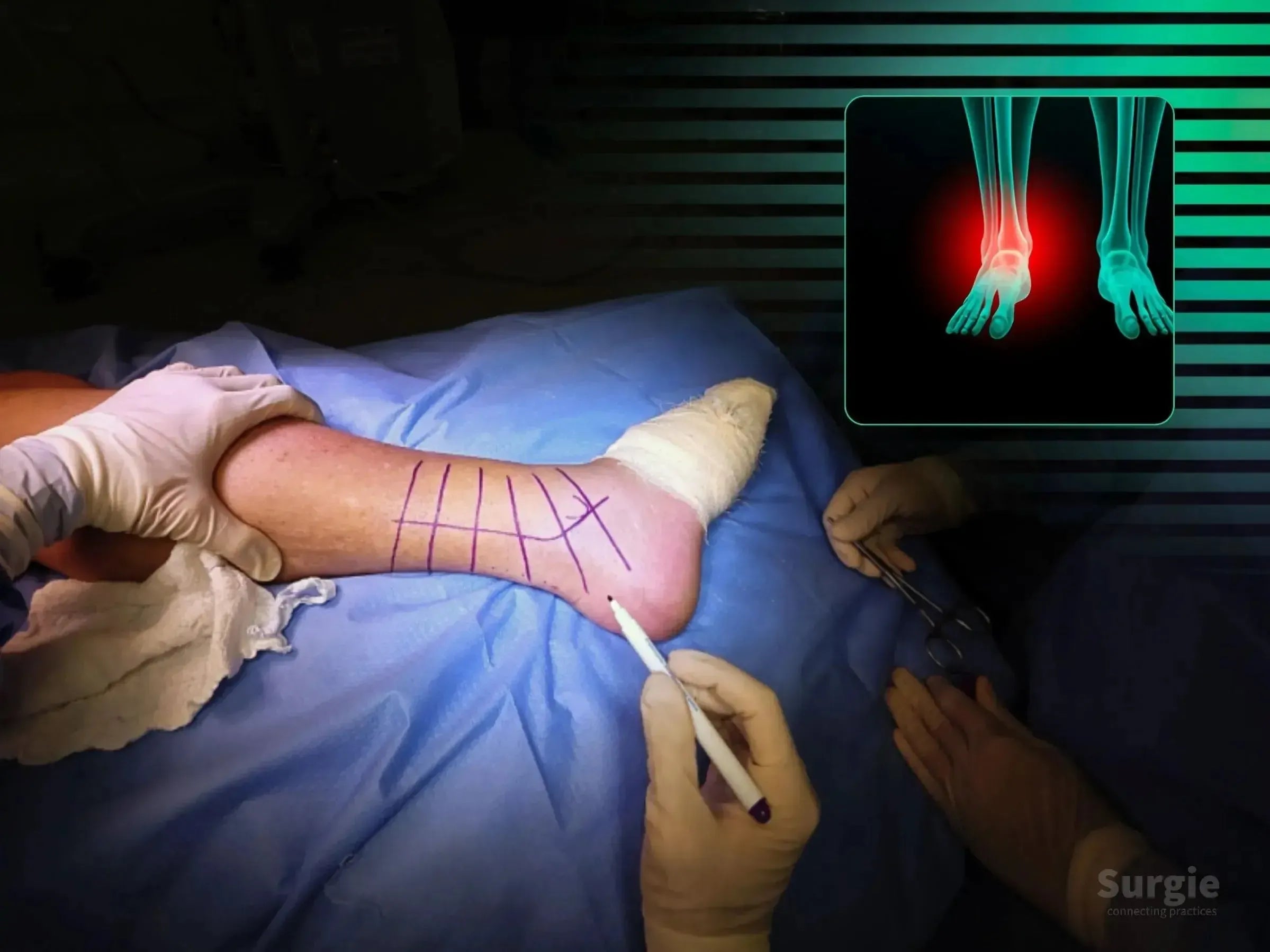 Surgeon marking a patient's ankle for trimalleolar fracture surgery with a digital anatomical overlay.