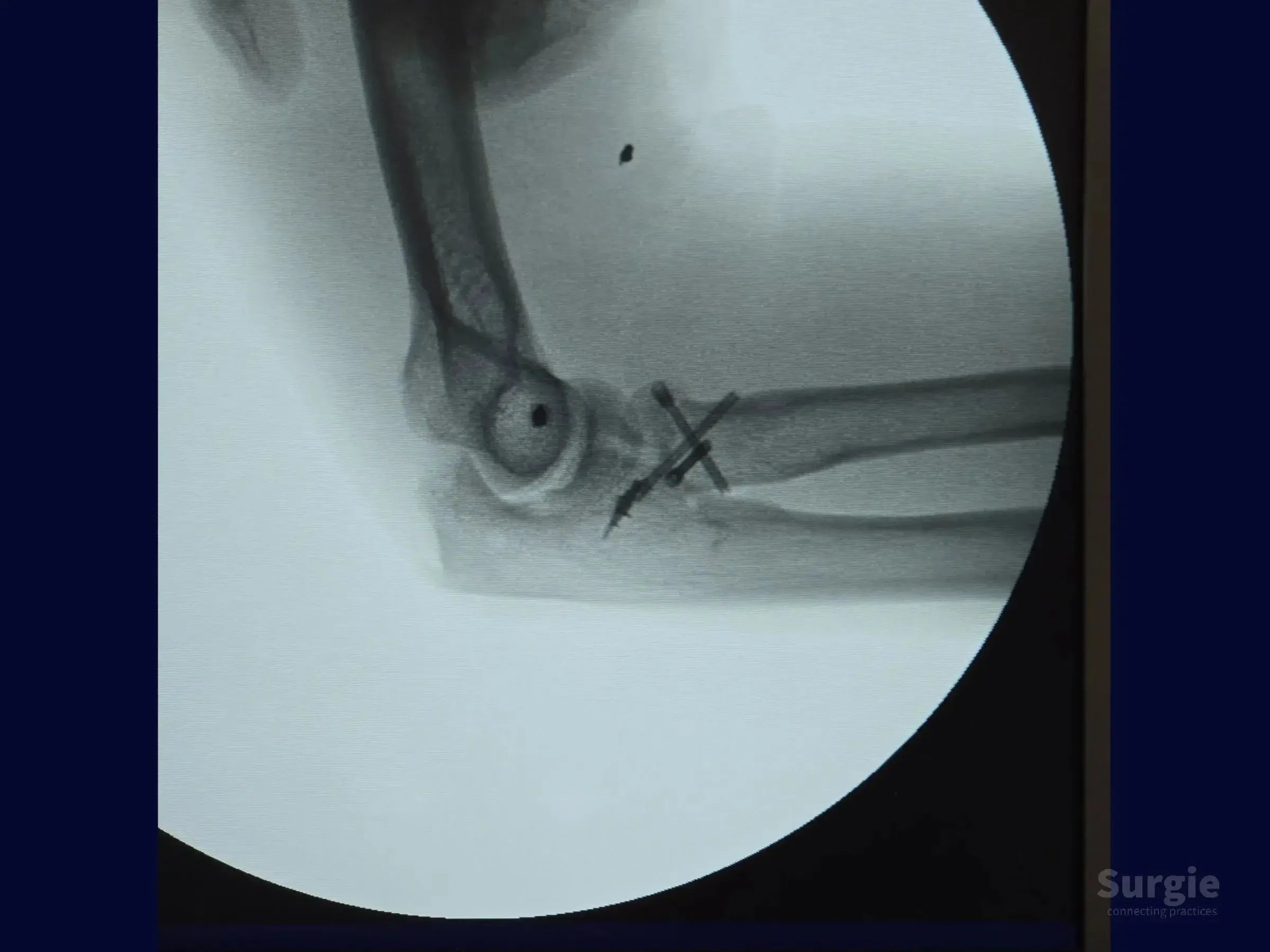 X-ray showing radial head fixation with crossed double-compression screws and a metallic anchor in the elbow joint.