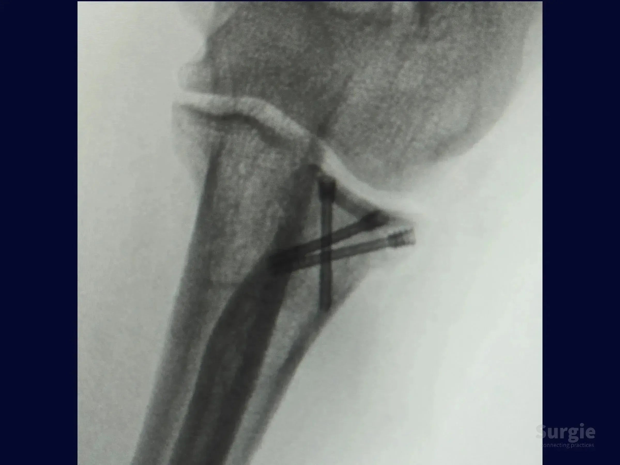 X-ray showing radial head fracture fixation with two crossed compression screws in a tripod configuration.