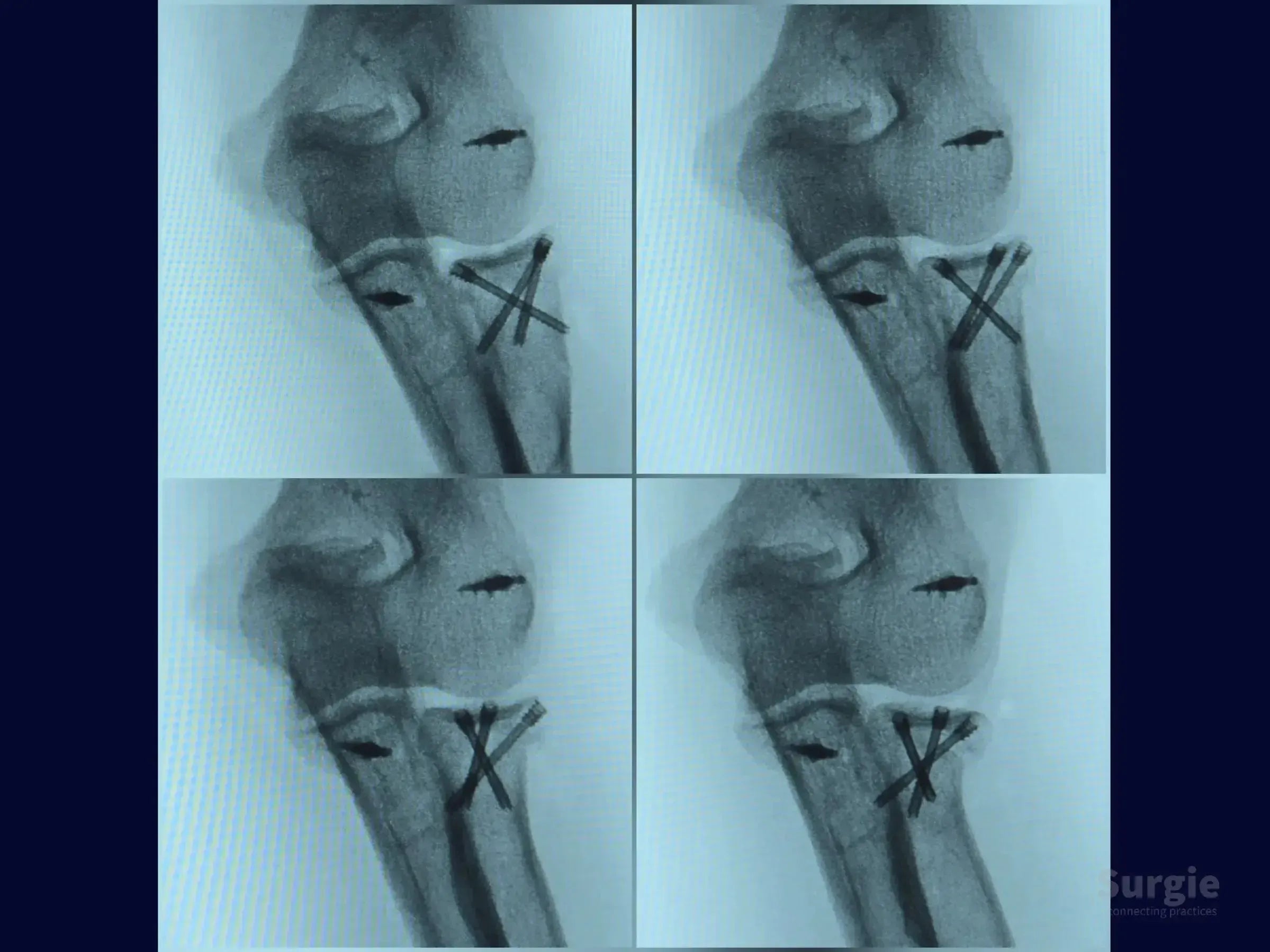 Fluoroscopic view of radial head fixation using crossed compression screws and a metallic anchor for joint stability.