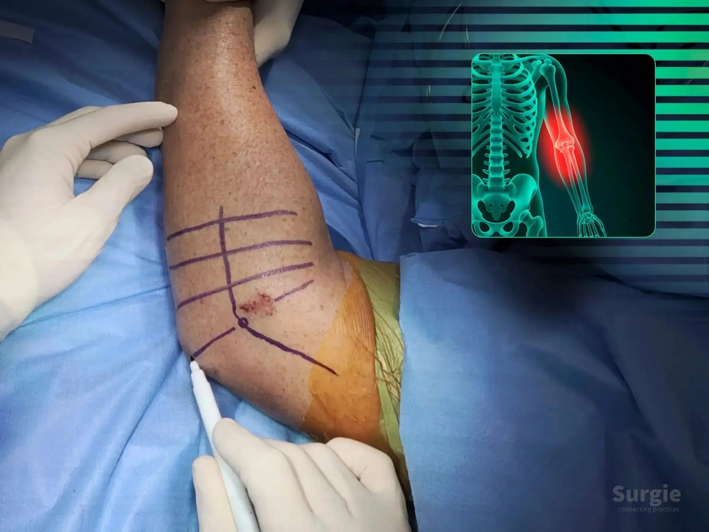 Surgeon marking a patient's elbow for radial head fixation surgery with a digital anatomical overlay of the joint.