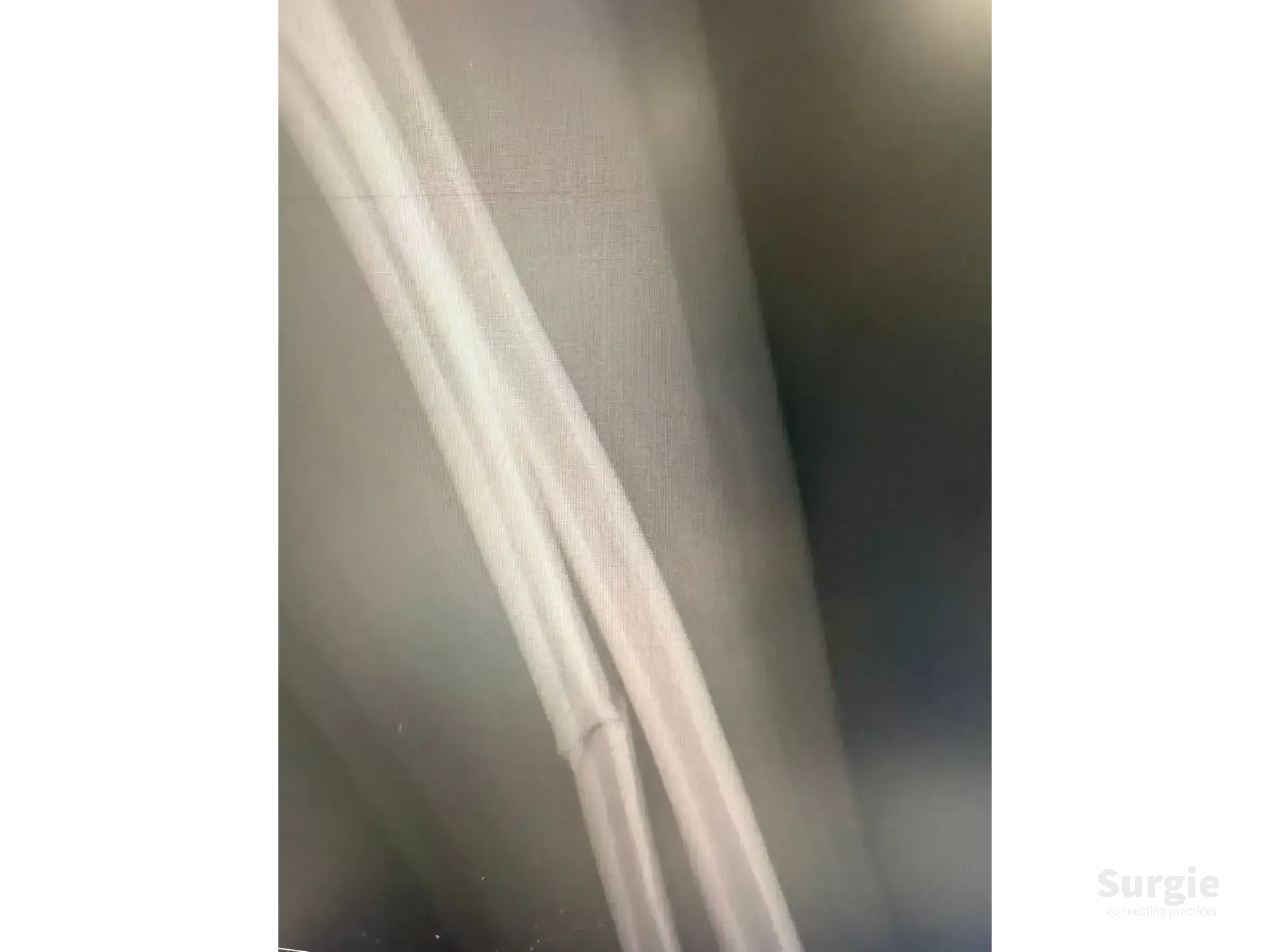 X-ray showing a displaced ulnar shaft fracture with a metal fixation plate and screws for anatomical reduction.
