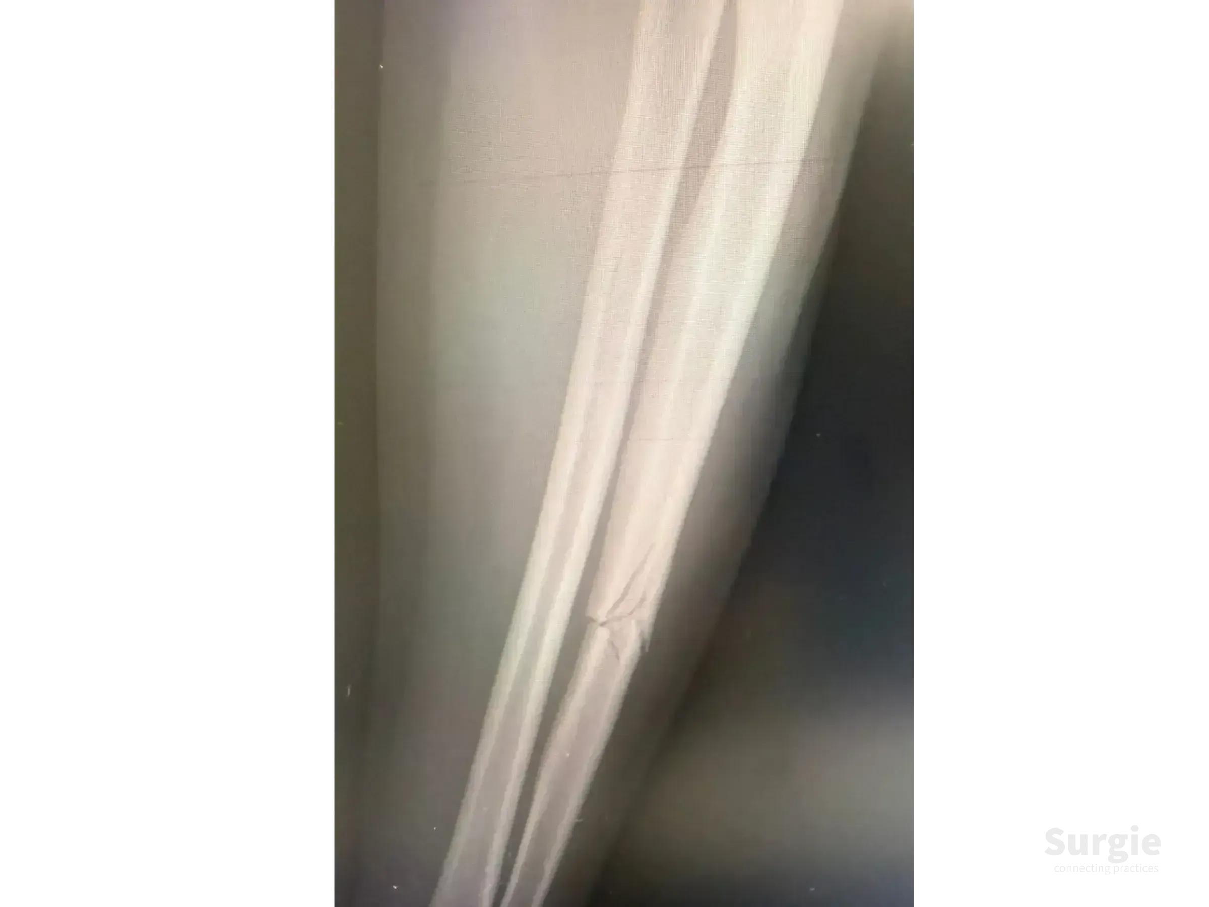 X-ray showing a displaced ulnar shaft fracture with a metal fixation plate and screws for anatomical reduction.