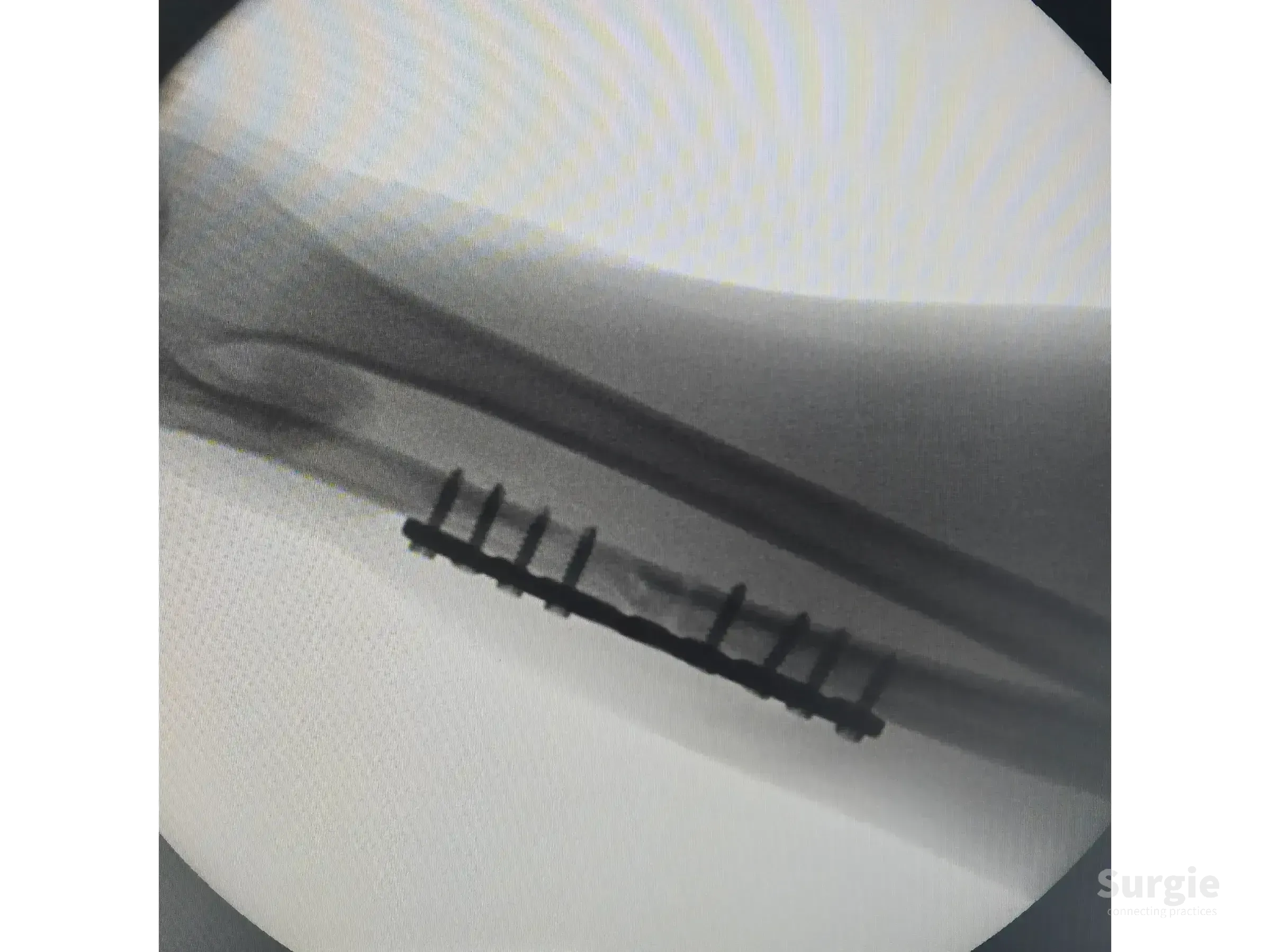 X-ray showing an ulnar shaft fracture stabilized with a metal orthopedic plate and multiple surgical screws.