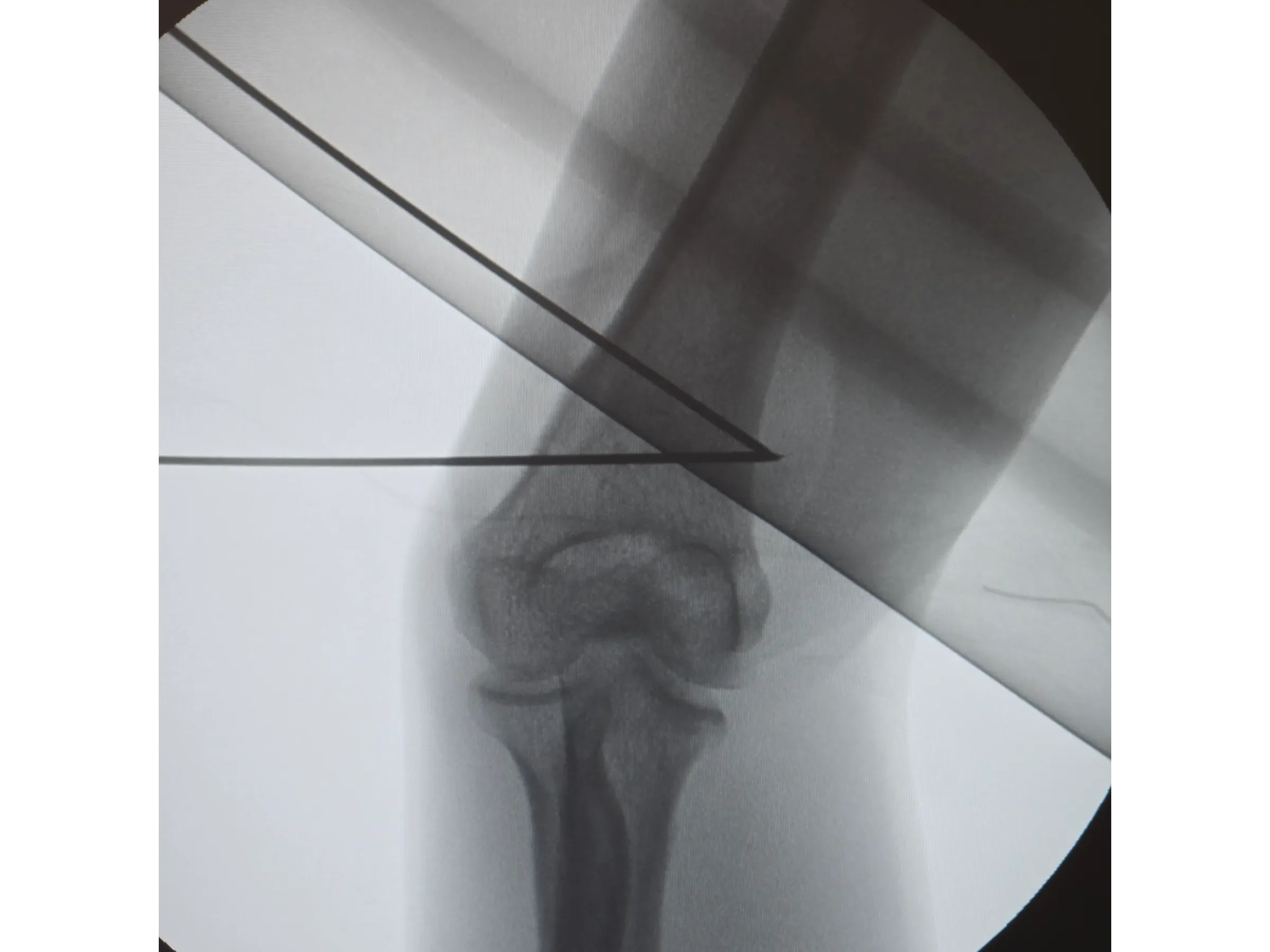 Distal Humerus Osteotomy – Cubitus Varus Deformity