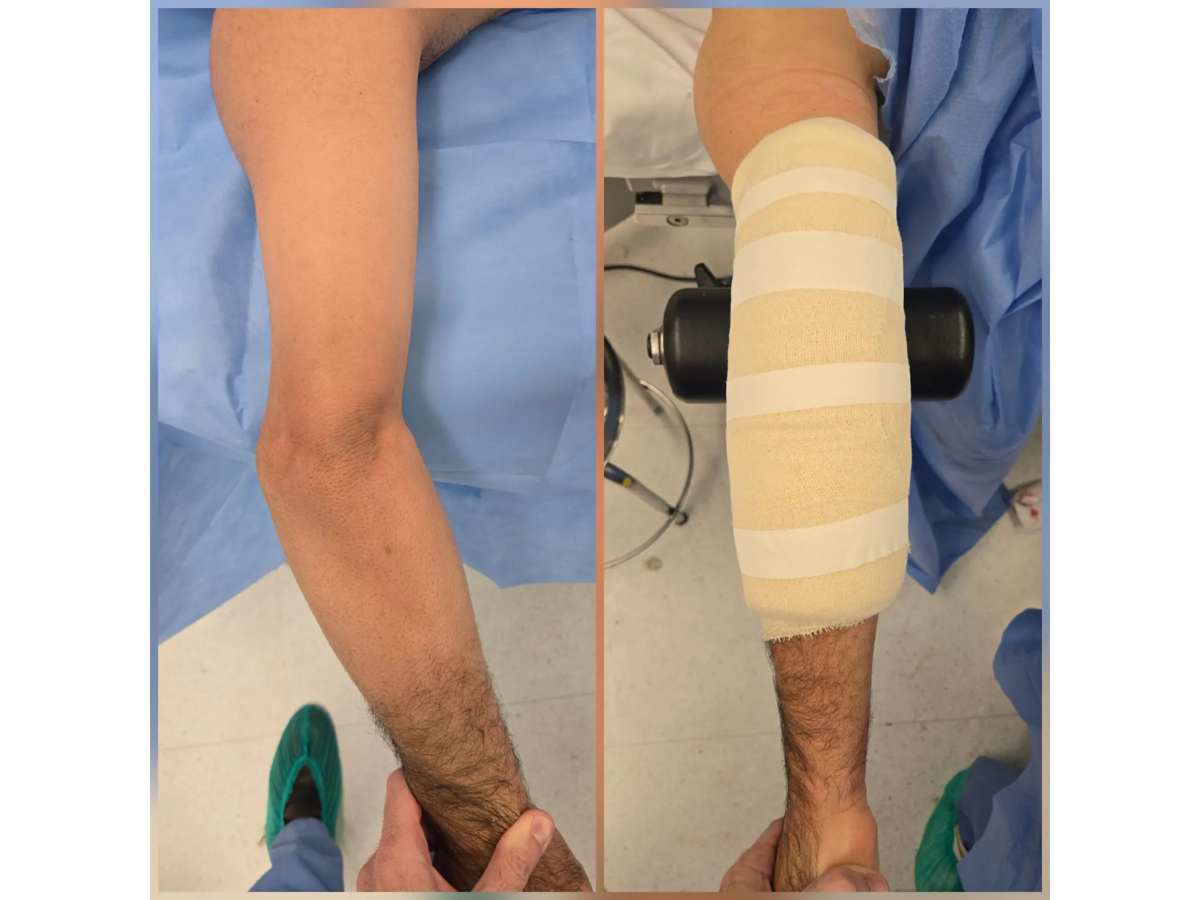 Distal Humerus Osteotomy – Cubitus Varus Deformity