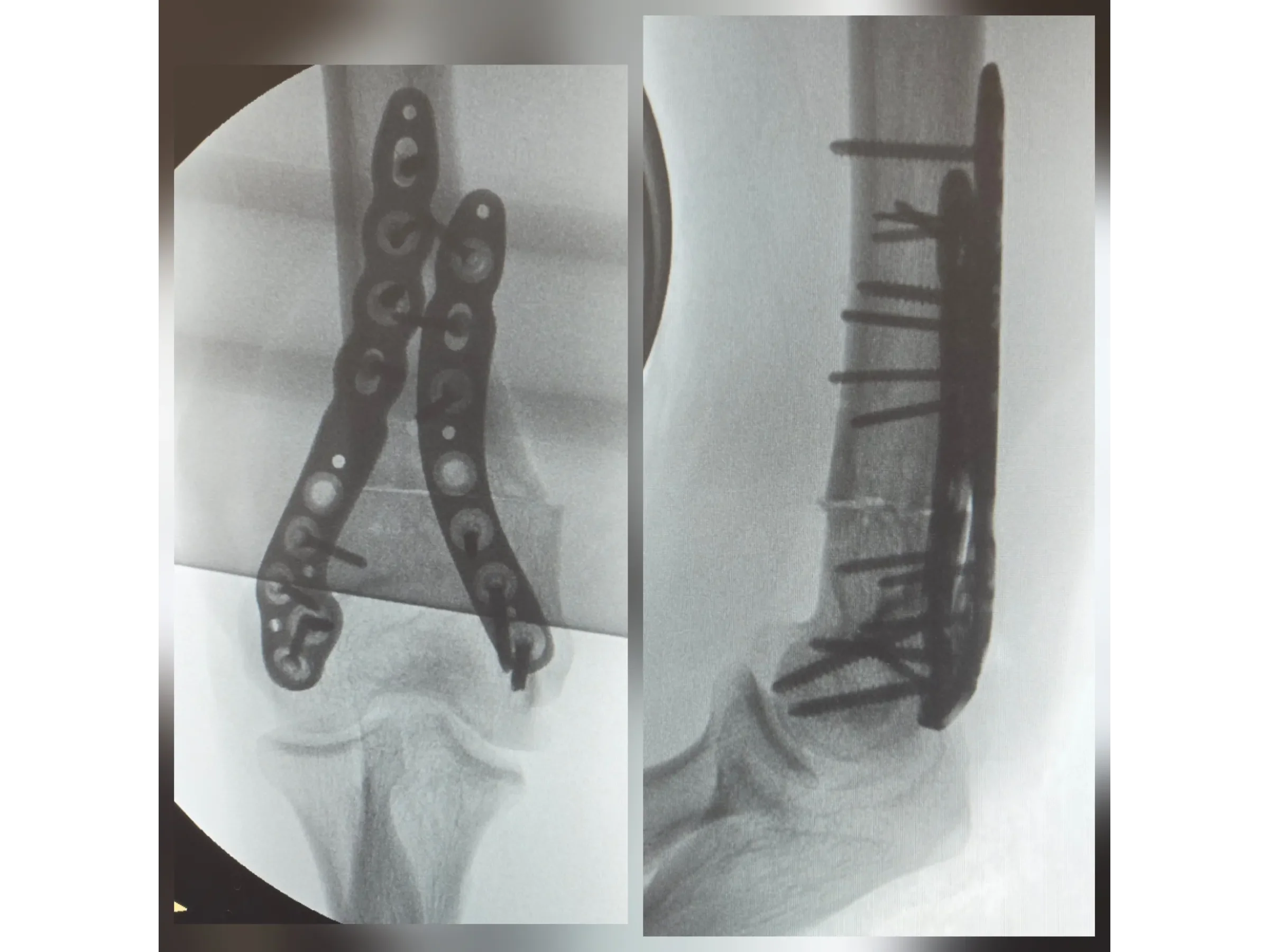 Distal Humerus Osteotomy – Cubitus Varus Deformity