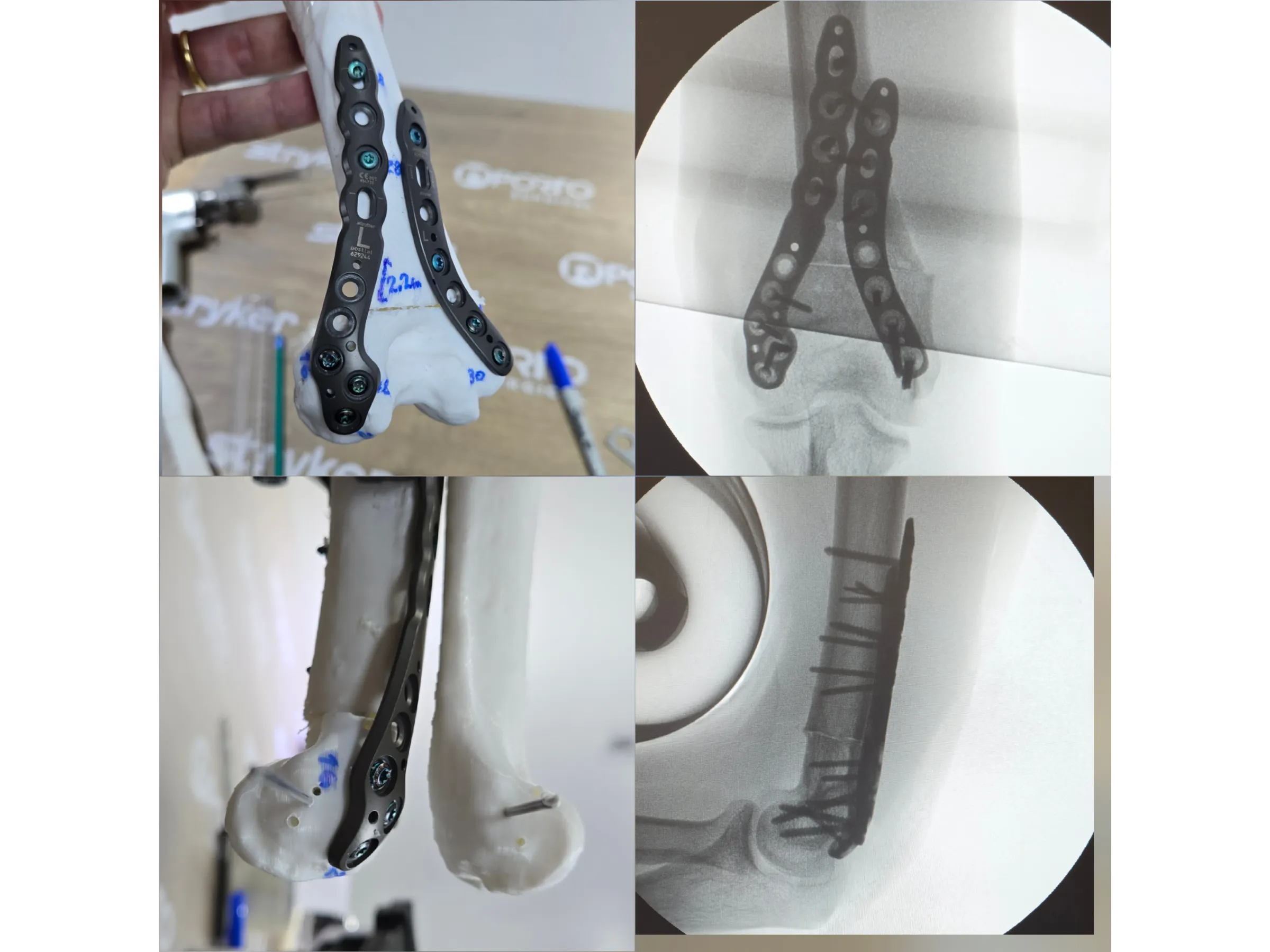 Distal Humerus Osteotomy – Cubitus Varus Deformity