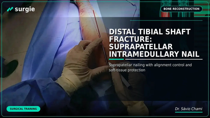 Distal Tibial Shaft Fracture: Suprapatellar Intramedullary Nail